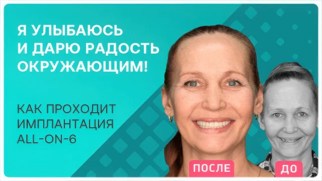 Технология All-On-6