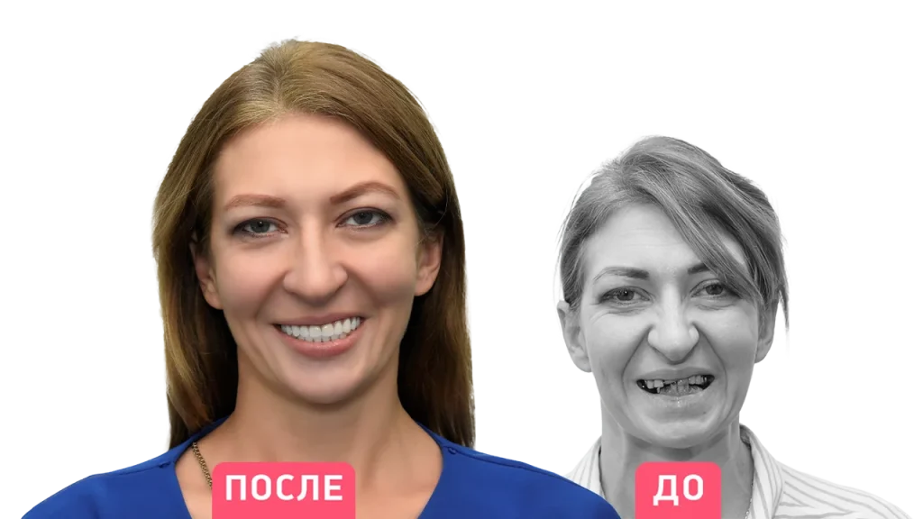 До и после имплантации зубов