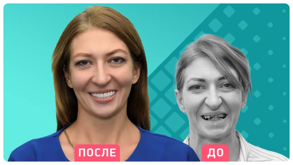 Технология ALL-ON-4