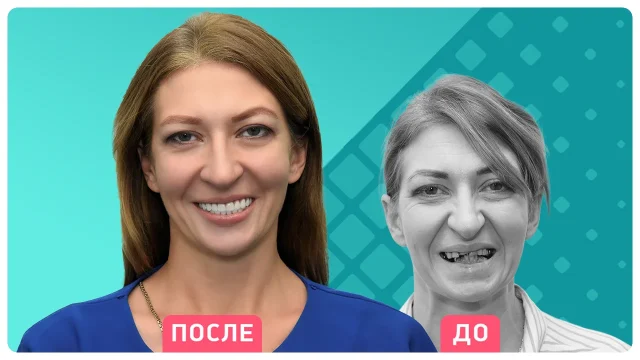 Технология ALL-ON-4