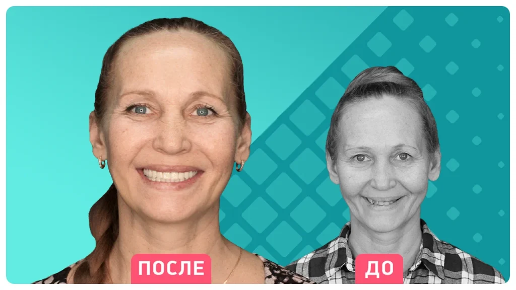 Технология All-On-6
