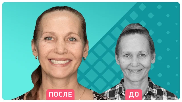 Технология All-On-6