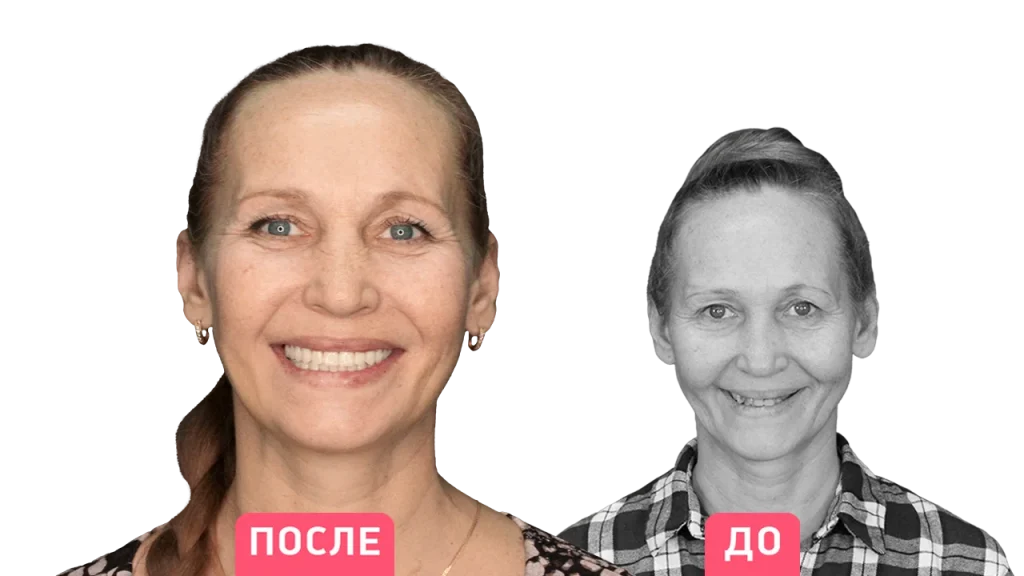 Пациент до и после имплантации