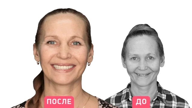 Имплантация без костной пластики: возможно ли