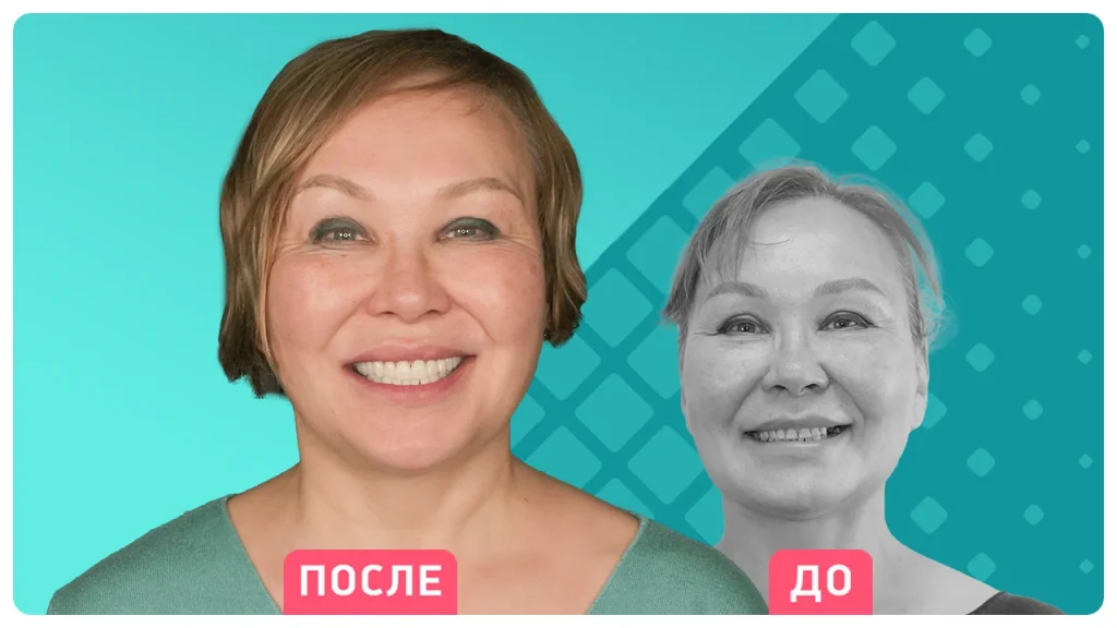 Одиночная имплантация
