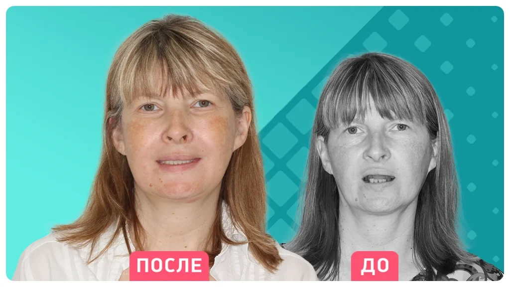 Технология Zygoma