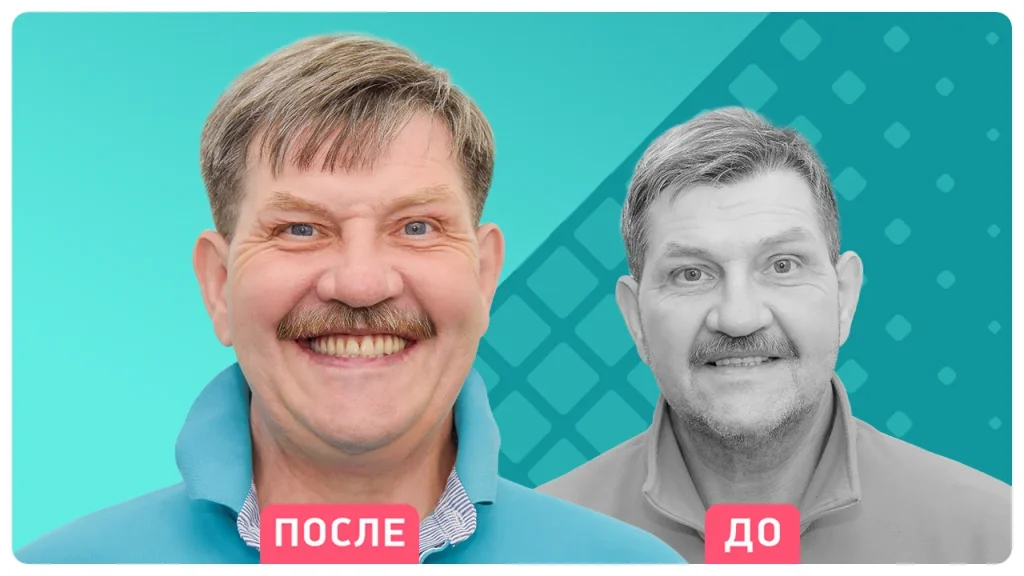 Технология Quadro Zygoma