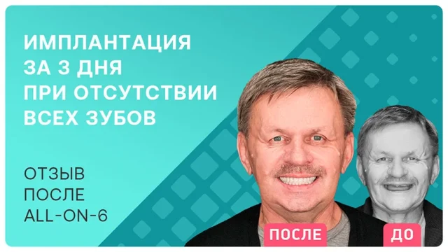 Имплантация all-on-6 за 3 дня
