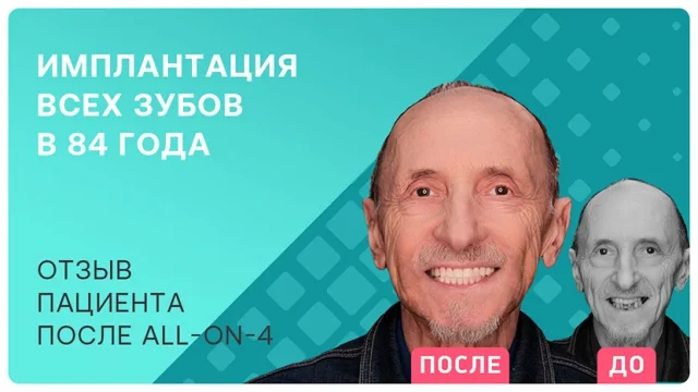 Имплантация зубов в 84 года