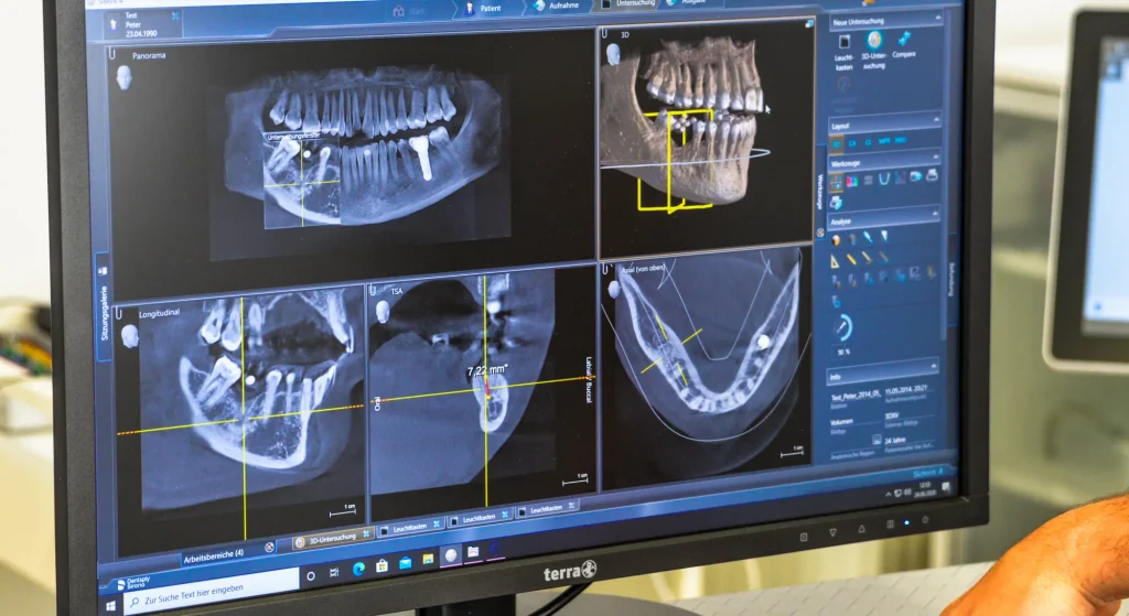 3D-диагностика и планирование имплантации зубов