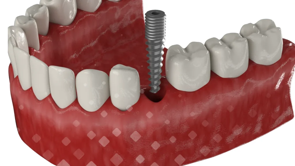 Этапы имплантации зубов