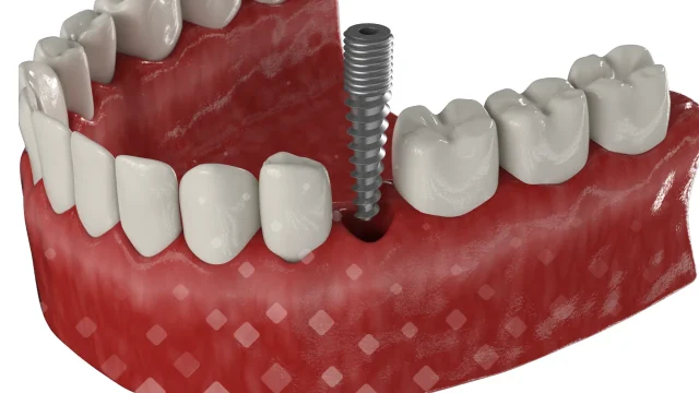 Этапы имплантации зубов: от консультации до результата