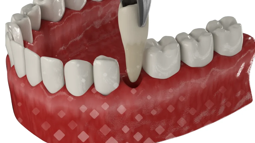 Удаление зуба