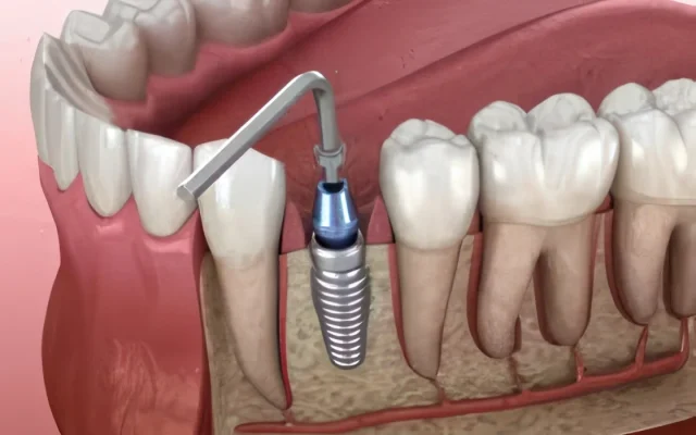 Сколько стоит имплантация одного зуба в Москве