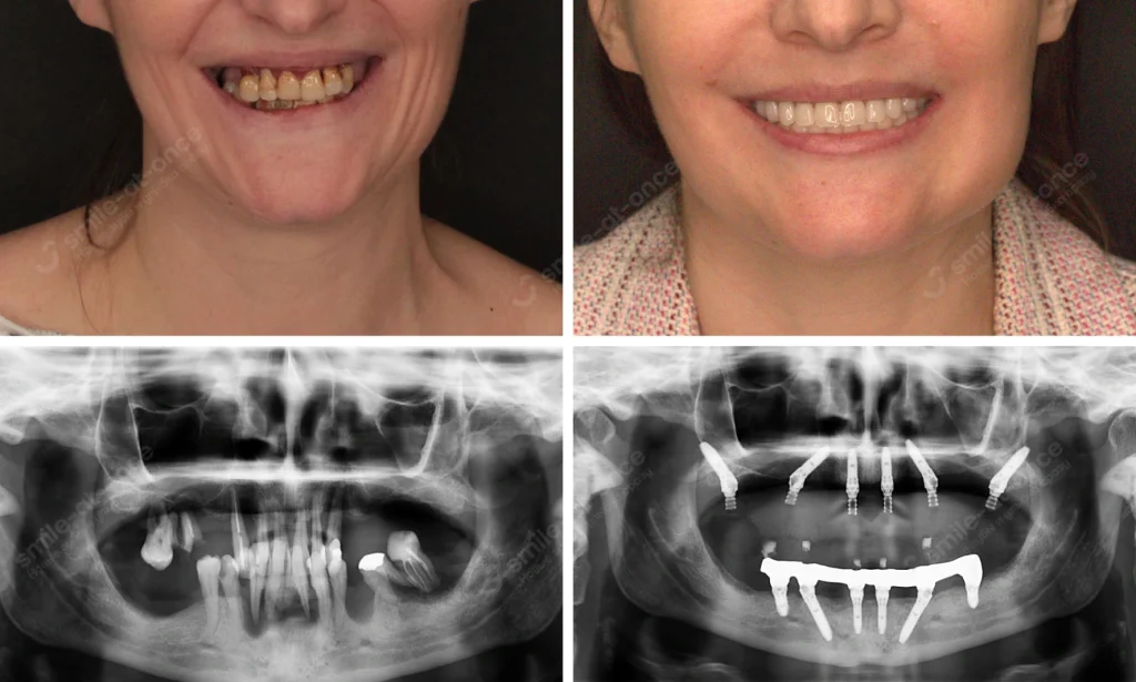 До и после имплантации V-II-V