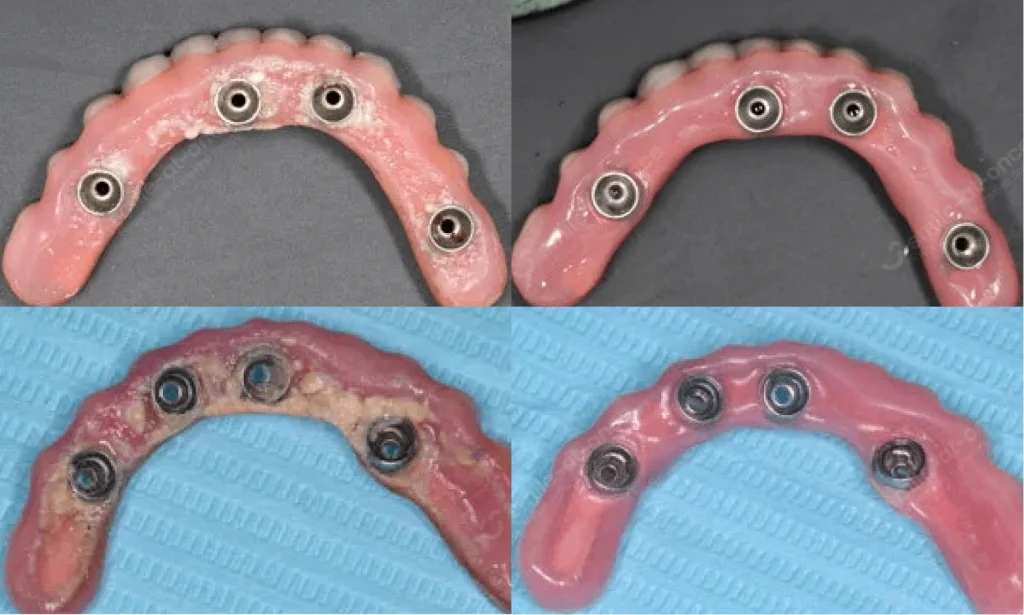 До и после профгигиены протезов на имплантах