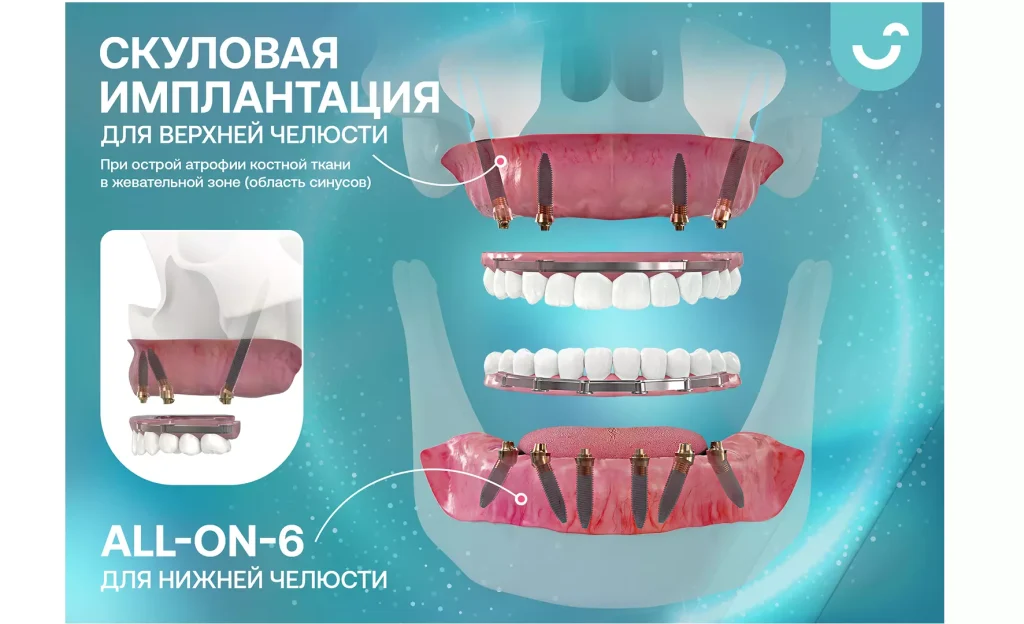 Скуловая имплантация