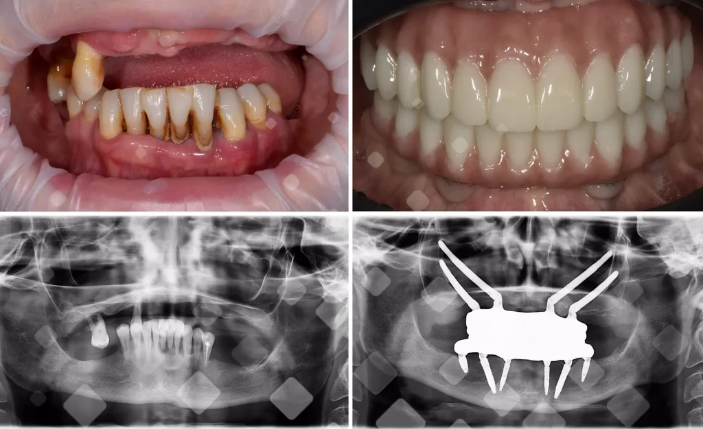 До и после имплантации