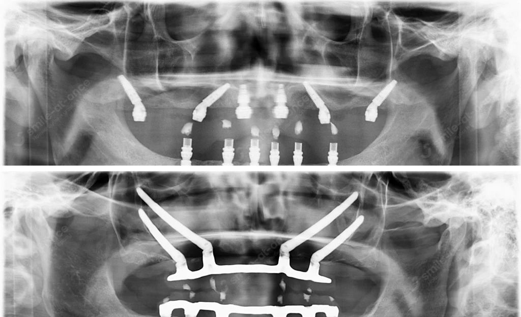 Компьютерная томография после установки имплантов