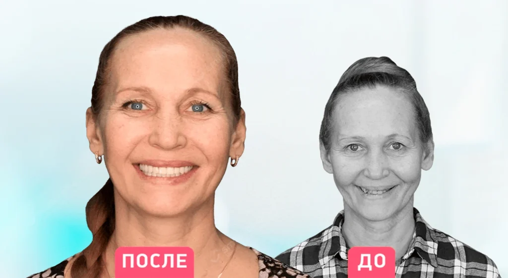 До и после имплантации зубов