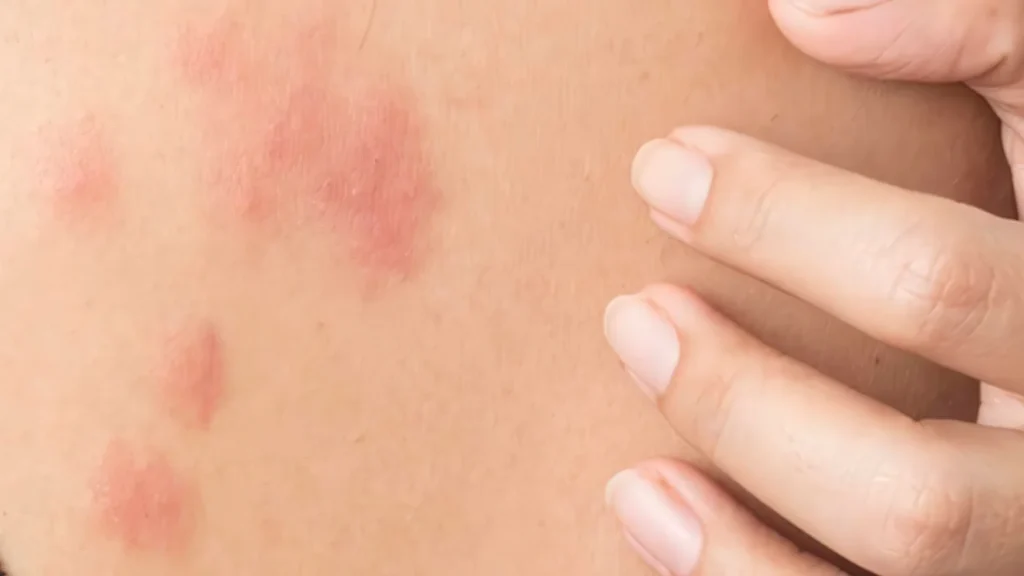 Как аллергия проявляется на коже