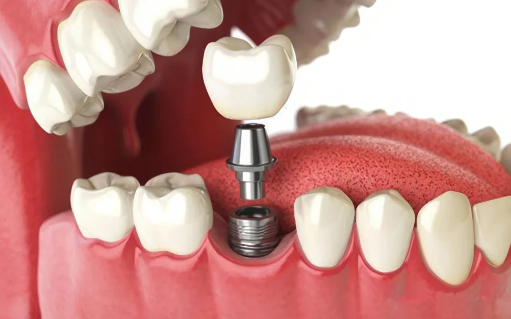 Установка абатмента на имплантат